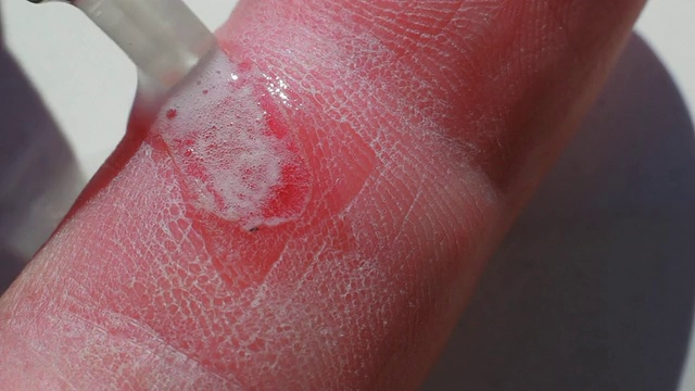 烧伤伤口消毒