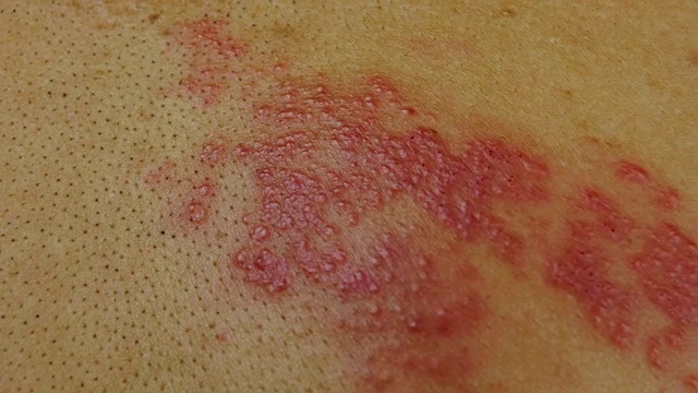 详情图-4k摄影由一种破坏人类神经的病毒引起的带状疱疹皮肤病