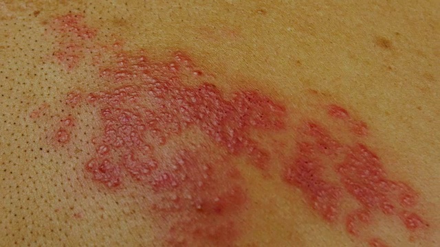 详情图-4k摄影由一种破坏人类神经的病毒引起的带状疱疹皮肤病