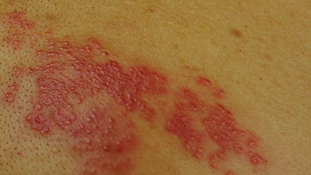 详情图-4k摄影由一种破坏人类神经的病毒引起的带状疱疹皮肤病