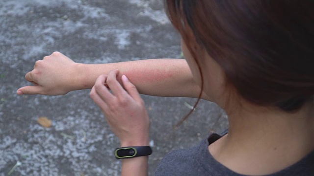 在肩膀上的女人抓挠她的胳膊上的皮疹