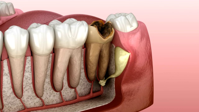 牙周炎-牙龈上的肿块。医学精确牙科3D动画