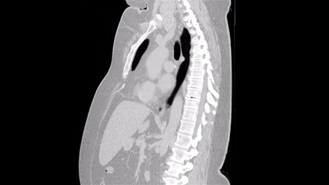 肺和支气管的MRI，病毒性呼吸道疾病的诊断