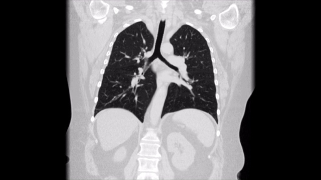 肺和支气管的MRI，病毒性呼吸道疾病的诊断