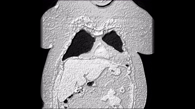 肺和支气管的大量MRI，诊断病毒或covid-19呼吸道疾病