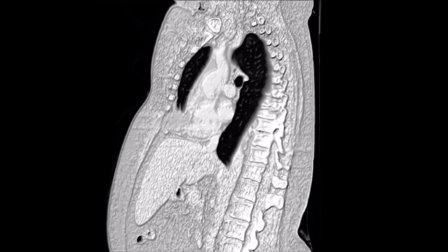 肺和支气管的大量MRI，诊断病毒或covid-19呼吸道疾病