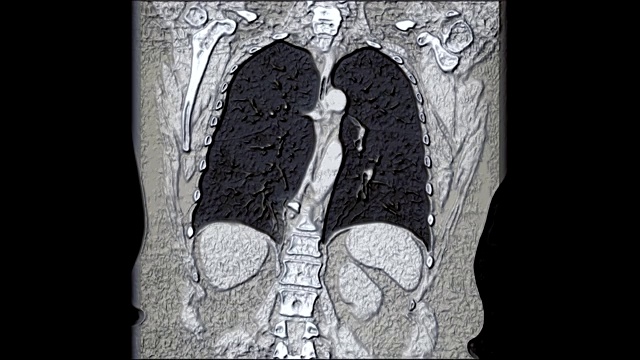 肺和支气管的大量彩色MRI，诊断病毒或covid-19呼吸道疾病