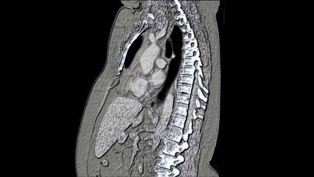 肺和支气管的大量彩色MRI，诊断病毒或covid-19呼吸道疾病