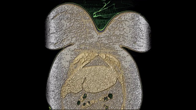 详情图-肺和支气管大面积彩色MRI，诊断病毒或covid-19呼吸道疾病
