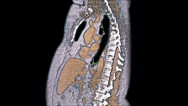 肺和支气管大面积彩色MRI，诊断病毒或covid-19呼吸道疾病