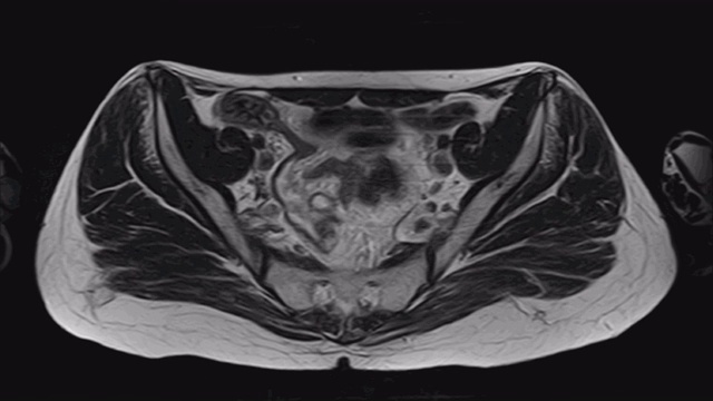 女性盆腔器官、腹腔、胃肠道、膀胱MRI