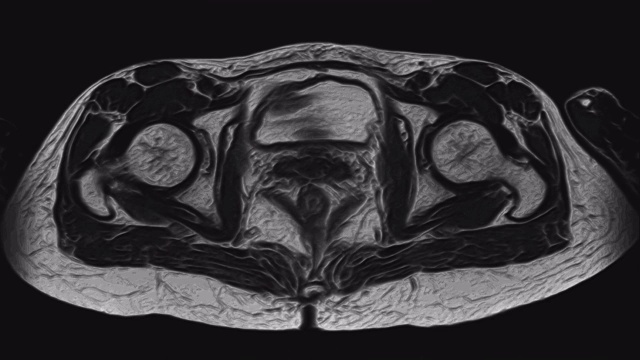 女性盆腔器官、腹腔、胃肠道、膀胱MRI