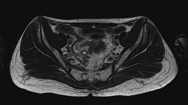 详情图-女性盆腔器官、腹腔、胃肠道、膀胱MRI
