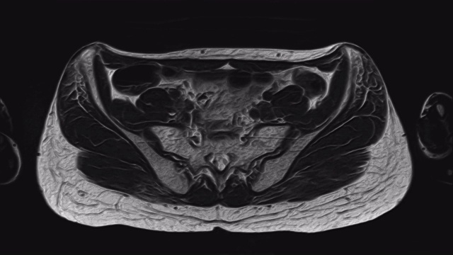 详情图-女性盆腔器官、腹腔、胃肠道、膀胱MRI