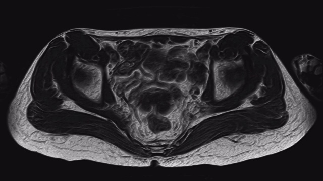 详情图-女性盆腔器官、腹腔、胃肠道、膀胱MRI