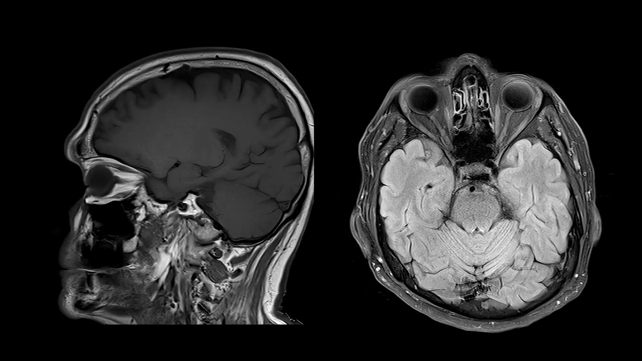 基于磁共振成像(MRI)的CT脑扫描图像