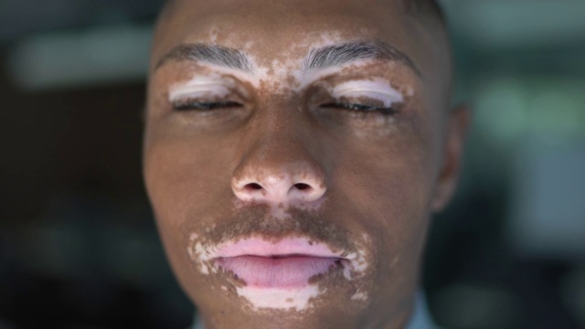 年轻男子白癜风的肖像