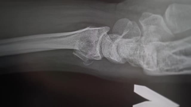 桡骨骨折移位的x光片。医生正在研究受伤的骨头。放射科医生在诊所做出了4k的诊断