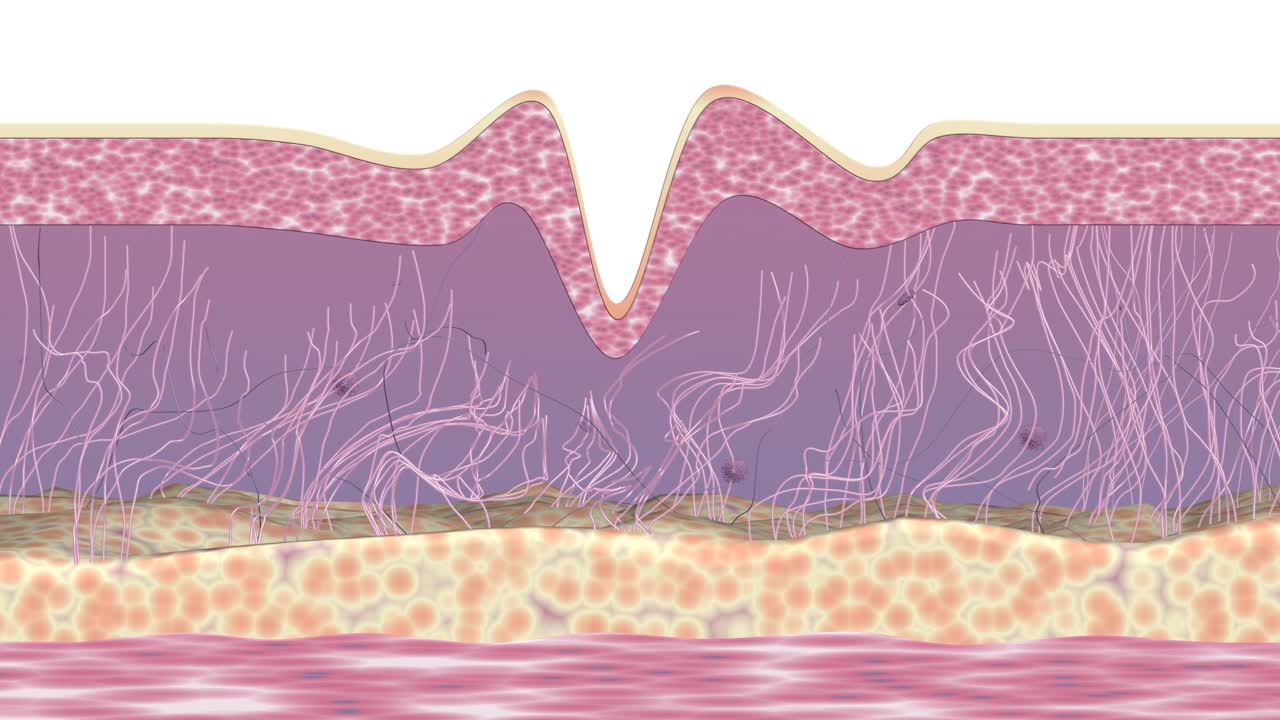 皮肤起皱纹治疗。医学三维动画。