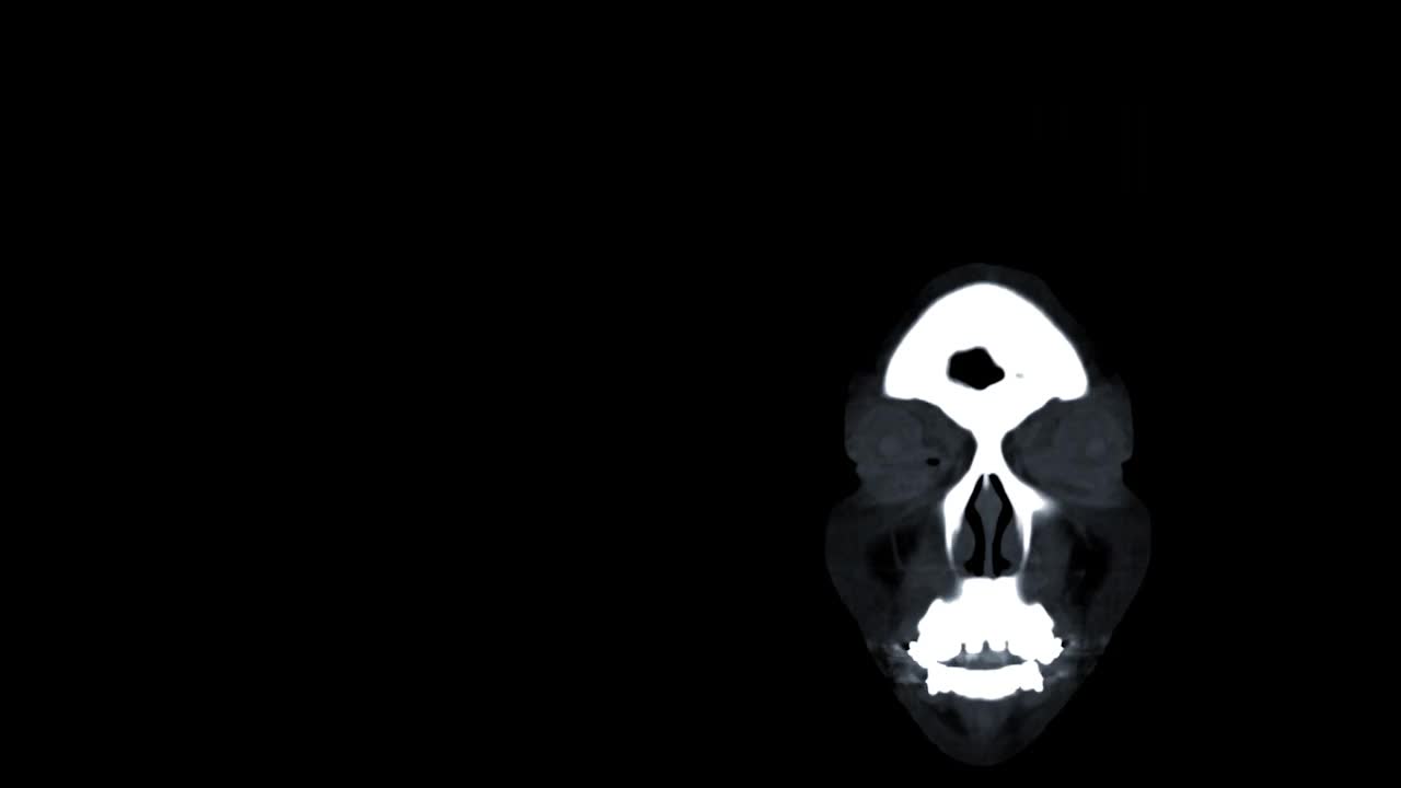 比较CTA脑或计算机断层血管成像的大脑3D和冠状面MIP图像。
