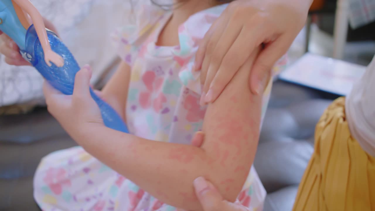母亲在给蹒跚学步的女儿涂乳液。过敏，孩子脸颊红肿