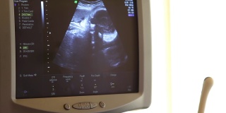 人体胚胎的医学超声扫描。24周婴儿的心脏