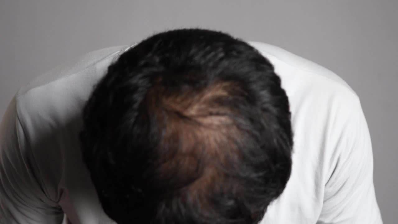 男子出现秃顶
