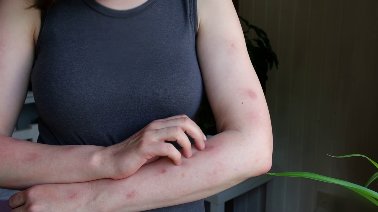 女人用疹子抓她的手，红斑，水泡。猴痘是一种危害全世界的新疾病。猴痘患者。近距离皮疹，人类与健康问题。副本的空间。