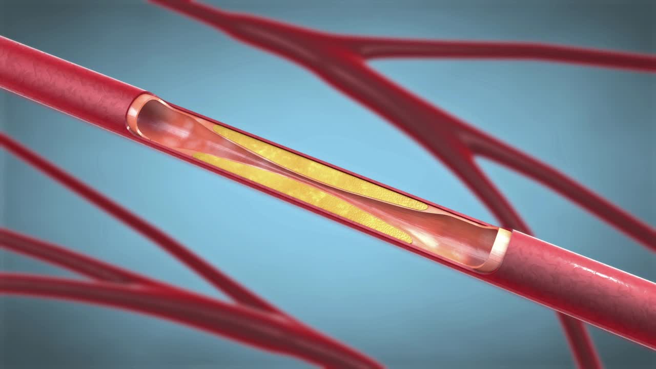 血管成形术中支持血管内血液循环的支架植入。3d插图