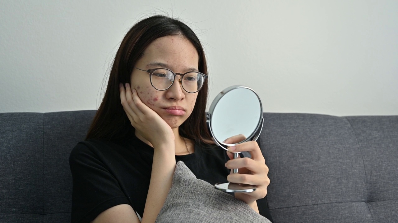 年轻的亚洲女性担心引起痤疮炎症和痤疮疤痕发生在她的脸上，而她在家里放松。