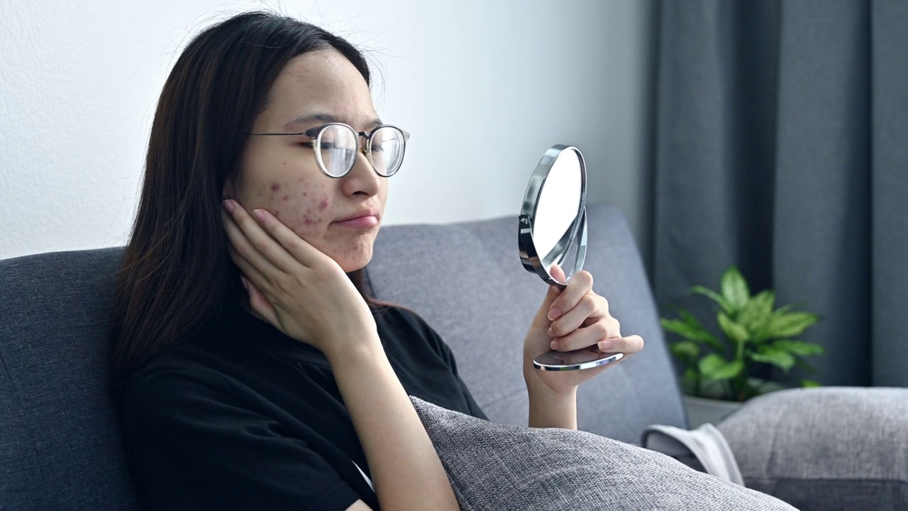 年轻的亚洲女性担心引起痤疮炎症和痤疮疤痕发生在她的脸上，而她在家里放松。
