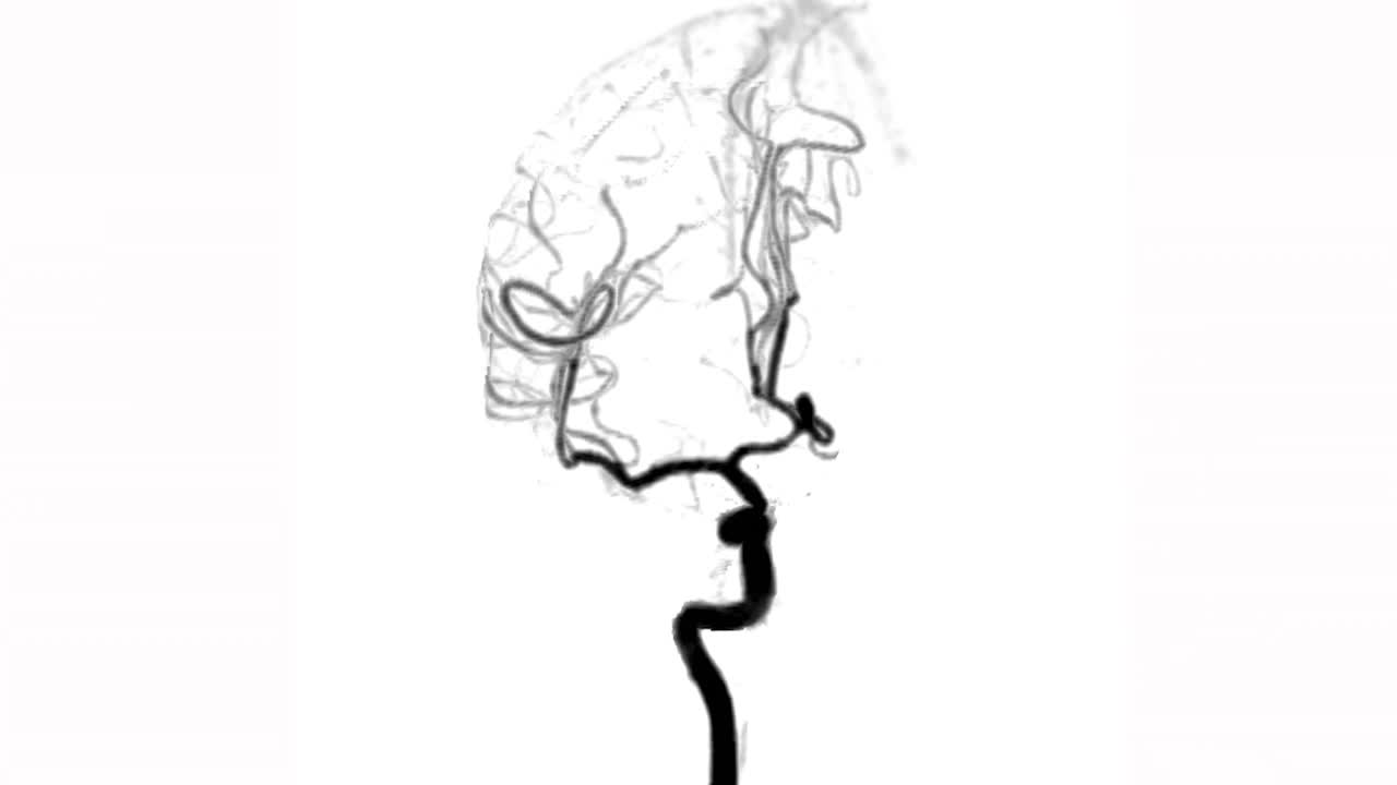CTA脑部扫描或计算机断层血管造影3D渲染。