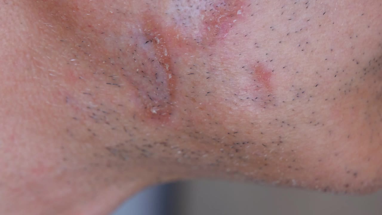 一男子面部皮肤结节病病例