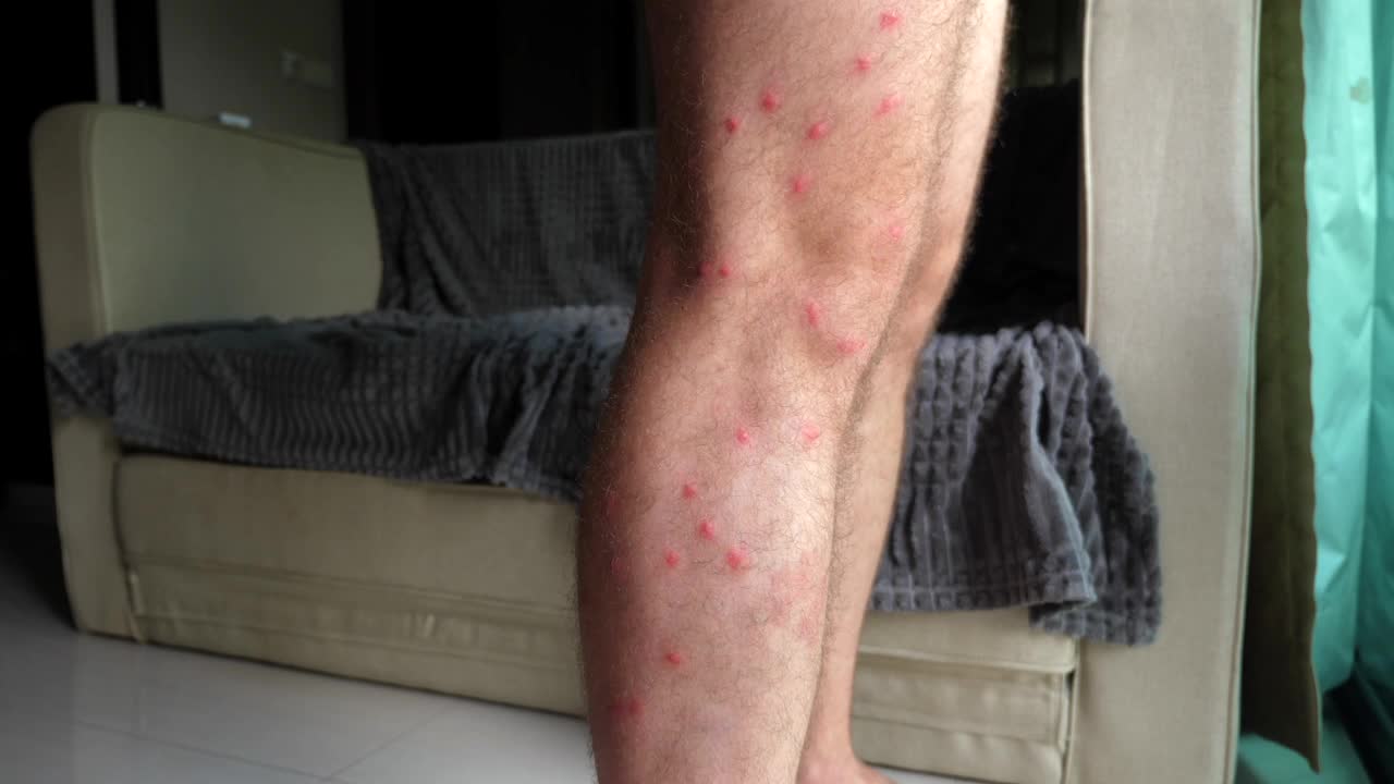 男子腿部特写，可见蚊虫叮咬
