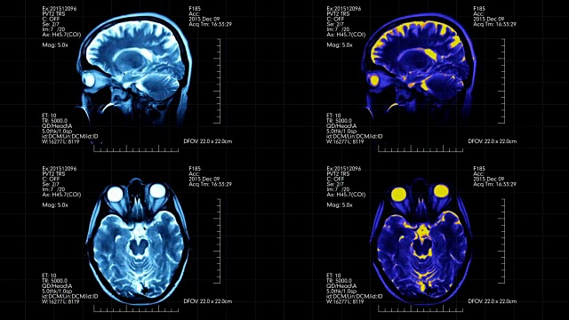 核磁共振脑部扫描未来显示四幅图片蓝色和蓝绿色在黑色的背景