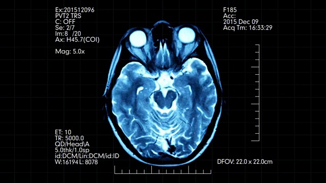 俯视图蓝绿色MRI脑部扫描显示动画数字和文字