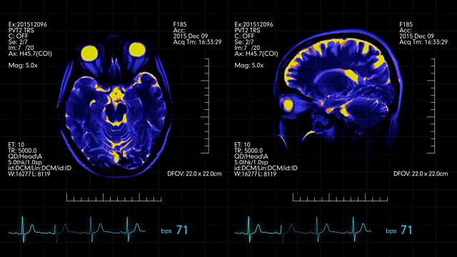 MRI大脑扫描未来显示蓝色和橙色与心率监视器