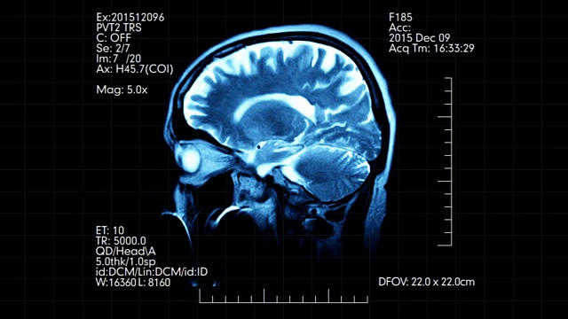 MRI脑扫描剖面动画与医学数据