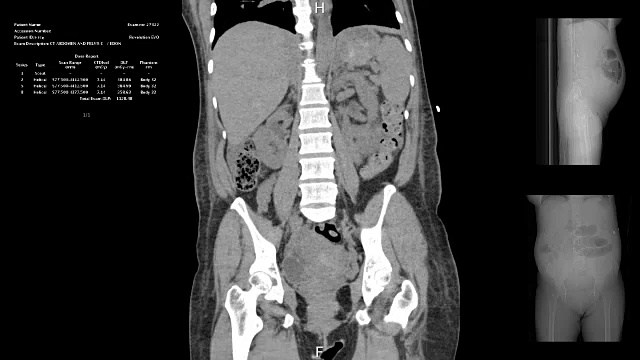 女性腹部轴向计算机断层扫描