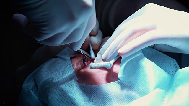 外科医生正在给眼睛做手术，特写镜头。矫正眼睛和眼睛。医生做眼睑成形术。手术在手术室进行。用手术刀和钳紧夹住瞳孔