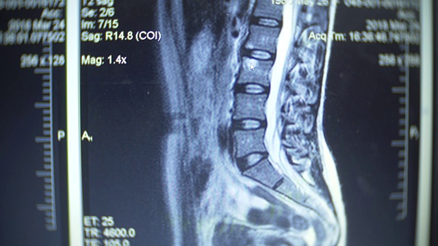 关闭。核磁共振成像的x射线图像。在电脑屏幕上显示磁共振治疗的结果。4k，模糊了帧边界。